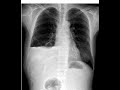 Chest X-ray air-fluid levels vs anatomy