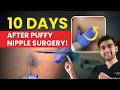Puffy Nipples Gone! Real Recovery Results After Gynecomastia Surgery | Dr DC, Plastic Surgeon