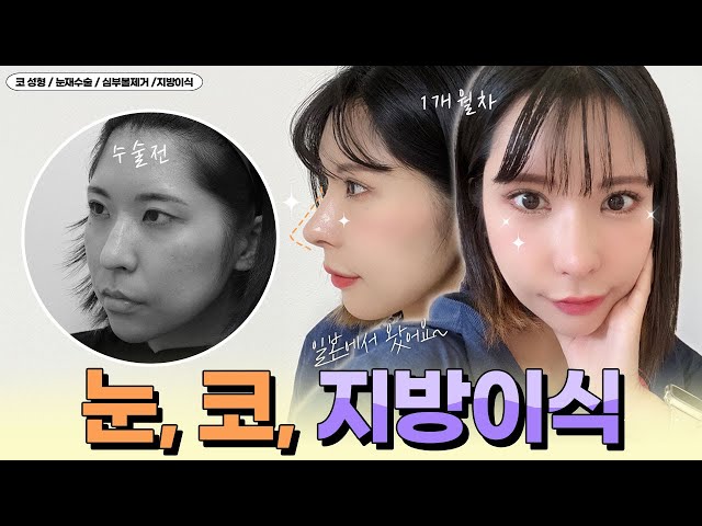 [VLOG] 눈재수술, 첫코, 지방이식💜 일본에서 왔어요~
