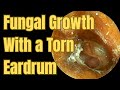 Fungal Growth With a Torn Eardrum