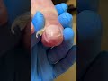 Silky Smooth Cut Away Ingrown Nails ~ Decompression #nails #satisfying