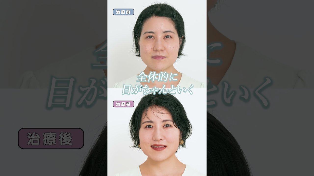 敏感肌のニキビ跡トラブルにはこれ！多色コンシーラーパレット使いこなし術！