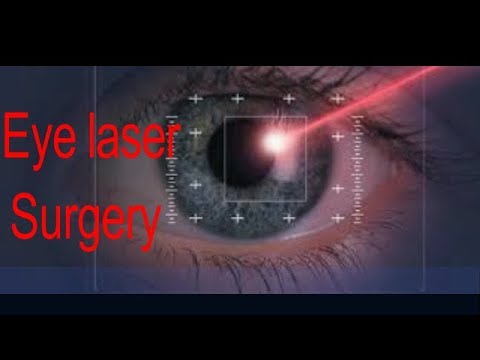 Lasik Laser Eye Surgery Operation In Urdu اپنی آنکھوں کالیزر سرجری کرنے سے پہلے یہ ویڈیو ضرور دیکھے Youtube