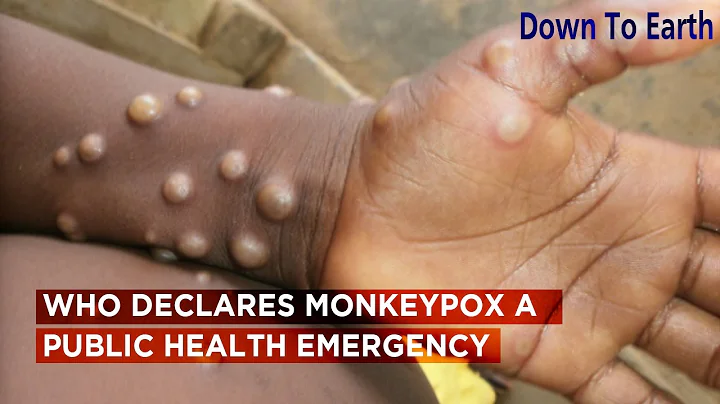 WHO declares Monkeypox a public health emergency of international concern - DayDayNews