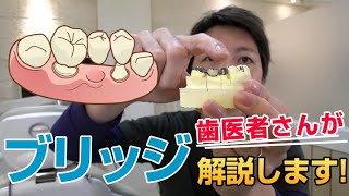 ブリッジを徹底解説！！★歯を失ったときに見る動画,入れ歯,インプラント,コンフォート,ソケット,痛い,Thorough explanation of the bridge