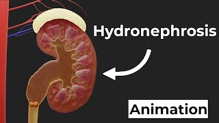 Kidney stones block urine flow | 3D-Animation