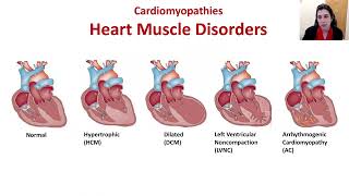Hypertrophic Cardiomyopathy (HCM): Identifying Symptoms and Confirming the Diagnosis