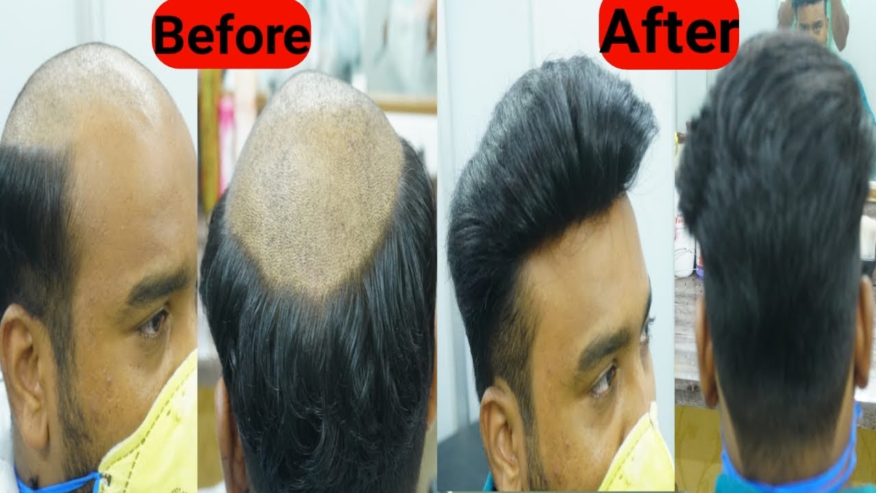 New Hair Without Surgery Hair bonding Hiar patch in Nagpur call on