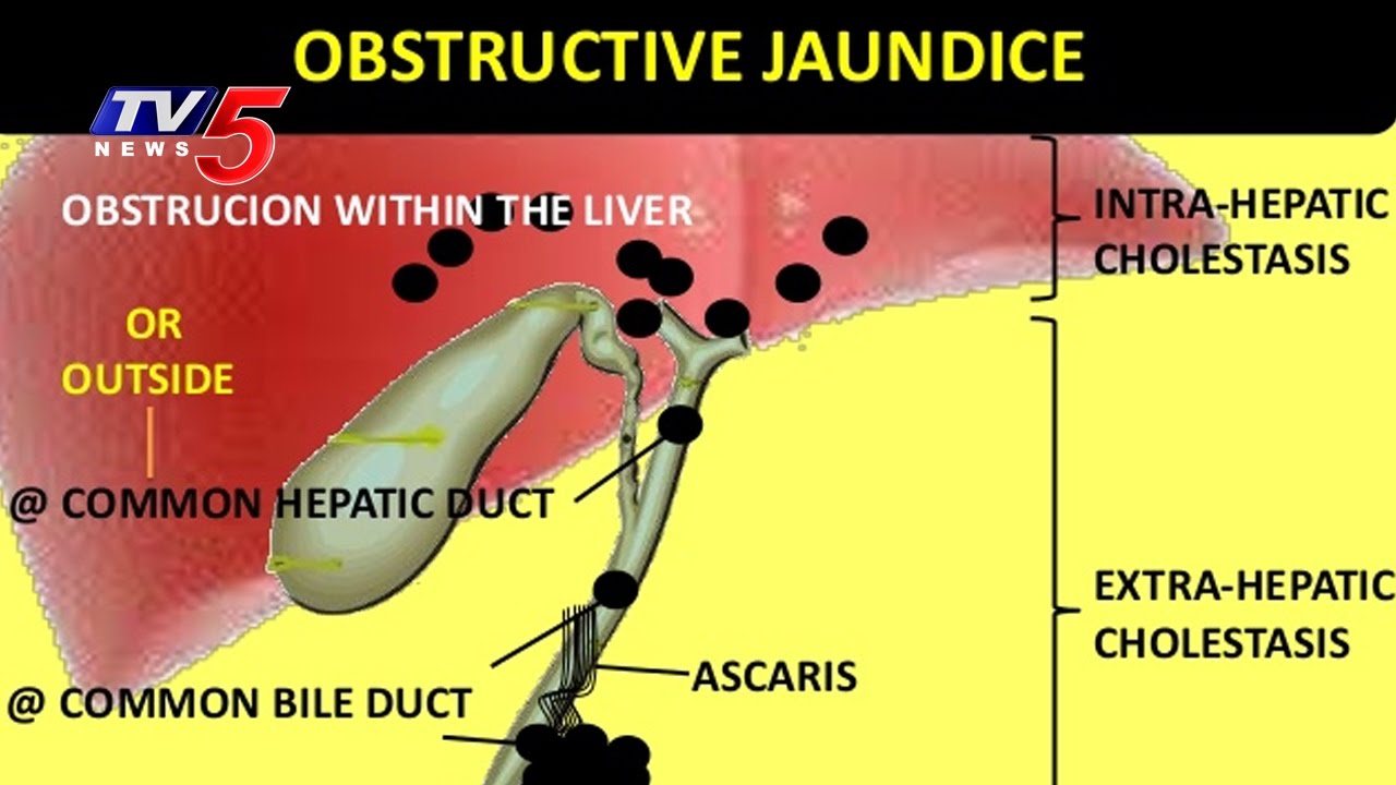 obstructive jaundice