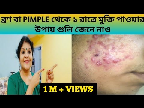 মাত্র এক দিনে ব্রণ বা PIMPLE থেকে মুক্তি পাও||অতি সহজ তিনটি ঘরোয়া উপায়ে ব্রণ কে করো টা টা বাই বাই||