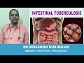 Intestinal Tuberculosis