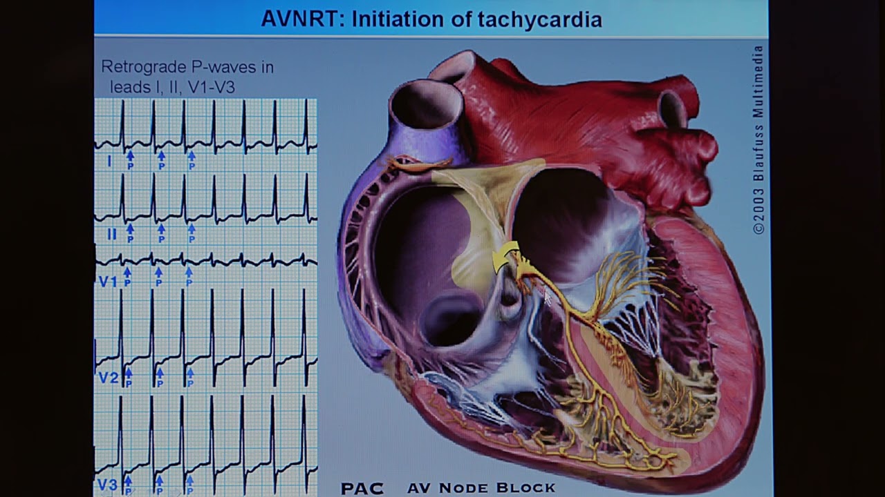 3. Entstehung der AV Knotentachykardie