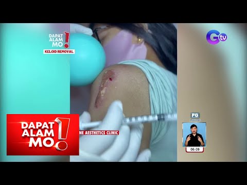 Video: Paano Tanggalin ang Keloid Scars: Makakatulong ba ang Mga remedyo sa Bahay?