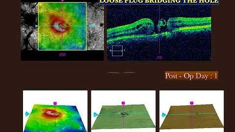 AIOC2018 - VT132 - The Macular Plug