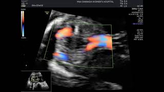 Two umbilical artery around bladder to rule out single umbilical artery@maa sharada women's hospital