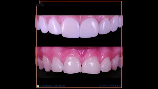 فينيير إسمايل | Direct composite veneer