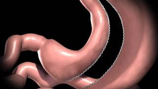 Bariatric Surgery - Sleeve Gastrectomy - obesity surgery - Dr Michael Hill Bariatric surgeon