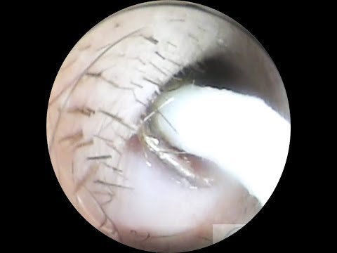 Vol.190【耳掃除】2週間前まで耳かきしてたのに・・・eariss