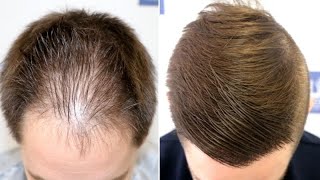 FUE Hair Transplant (2046 Grafts - DPA) By Dr Juan Couto - FUEXPERT CLINIC, Madrid, Spain