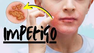 Bacterial Rash of Lips