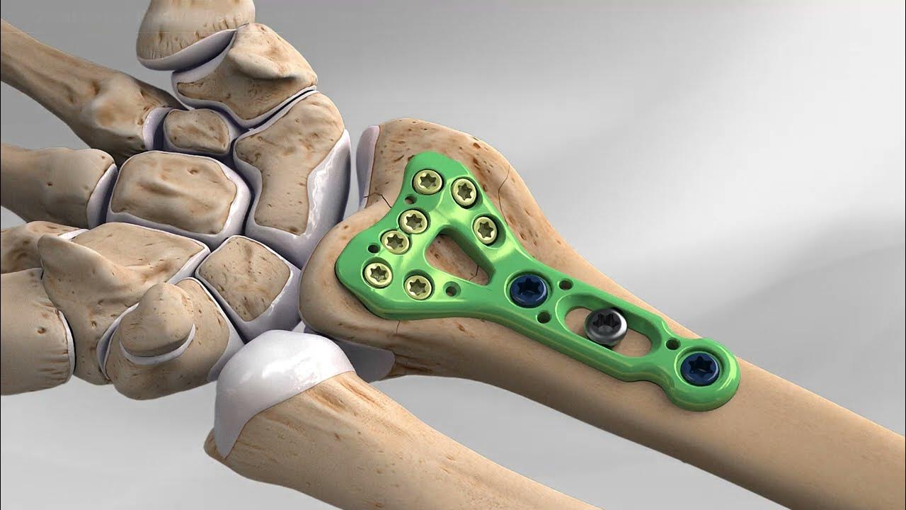 Distal Radius Fracture ORIF Distal Radius Open Reduction and Internal