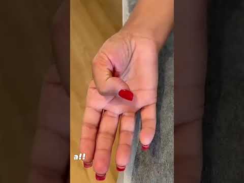 Tetik Parmak Sendromuna