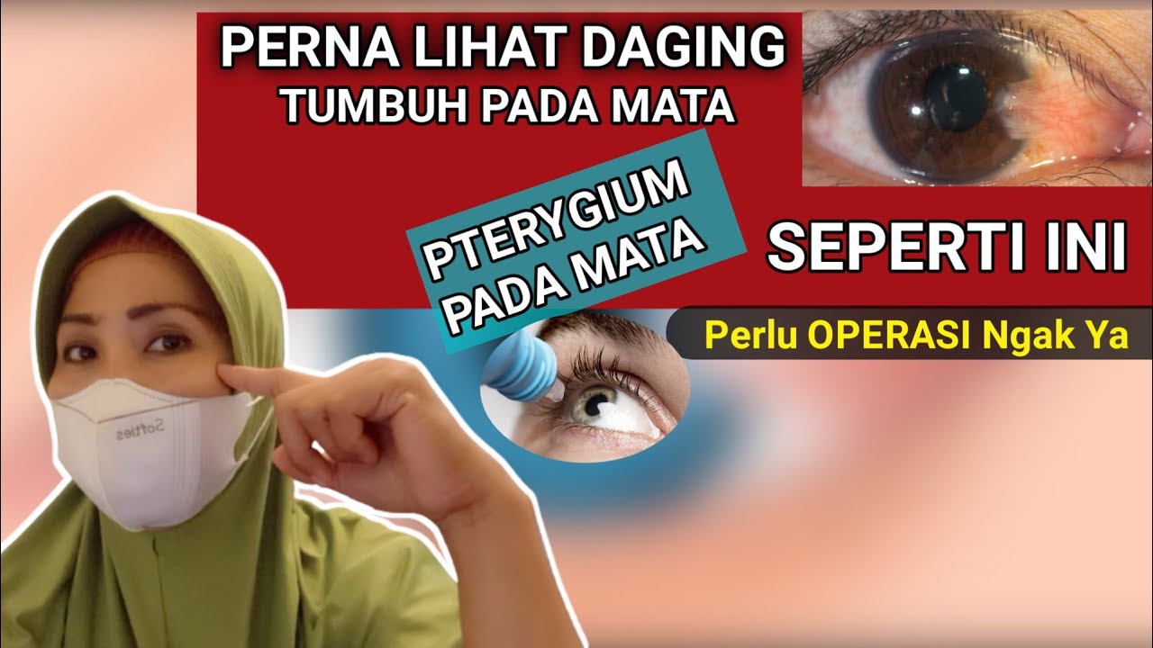 Наросты на глазах или крыловидная плева — симптомы и причины возникновения