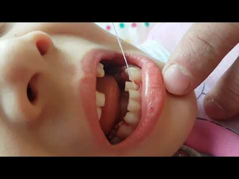 Diş çekimi ip ile 😊 - Tooth extraction