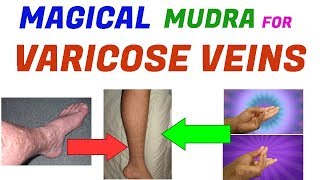 Mudra For Varicose Veins/Yoga Mudra For Varicose Veins/Hand Mudra For Varicose Veins
