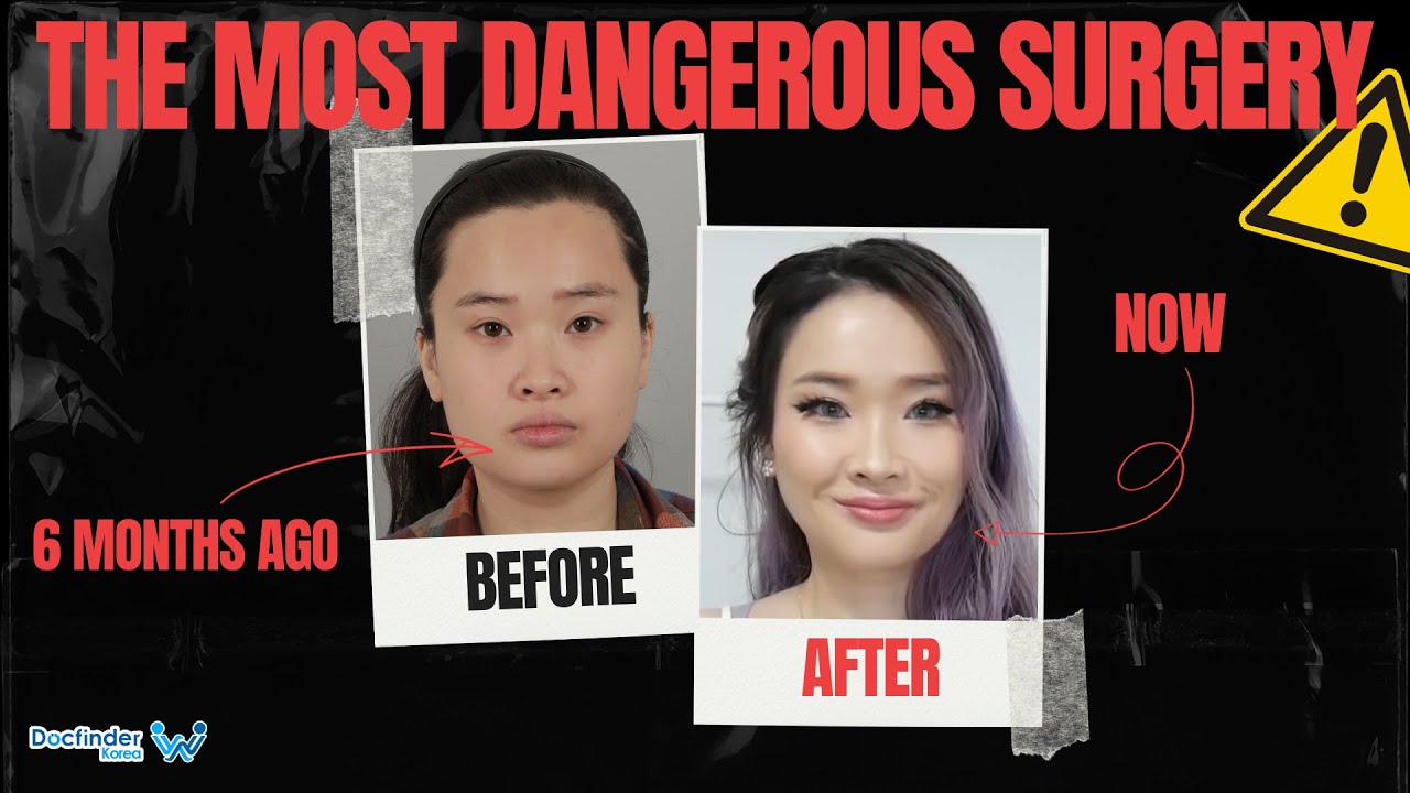 How to survive Two Jaw surgery! Two jaw surgery in Korea | Food tales