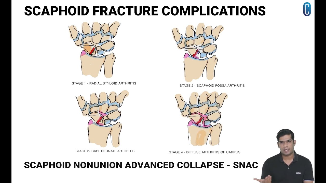scaphoid-fracture-complications-orthopedic-pg-exams-concise-youtube