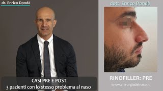 Rinofiller Pre E Post Trattamento Dr. Enrico Dondè