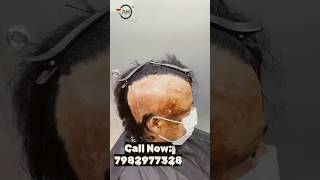 Aadhe jale sir par lagaya,Customized Hair Patch,Call 7982977328 #Customized #hairpatch #dhurandhar