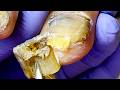 Extremely Long Onychomycosis Nails, Clean From The Root!【Xue Yidao】