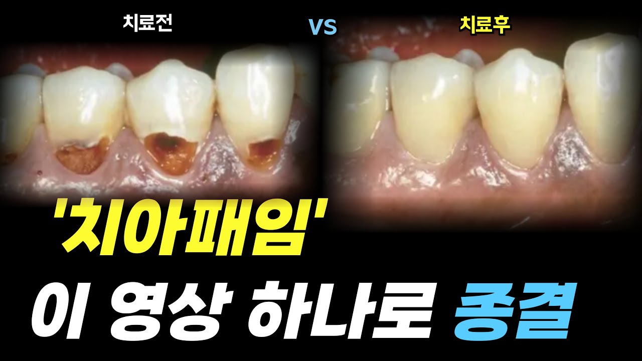 잇몸 내려간 치아패임? 원인,증상,해결법 총정리! 이 영상 하나로 다 알려드립니다..