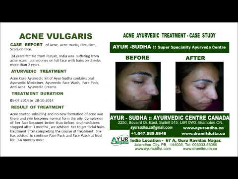 Ayurvedic treatment for Acne Vulgaris, Rosacea, Cystic Acne at Brampton, Canada. ayursudha.ca