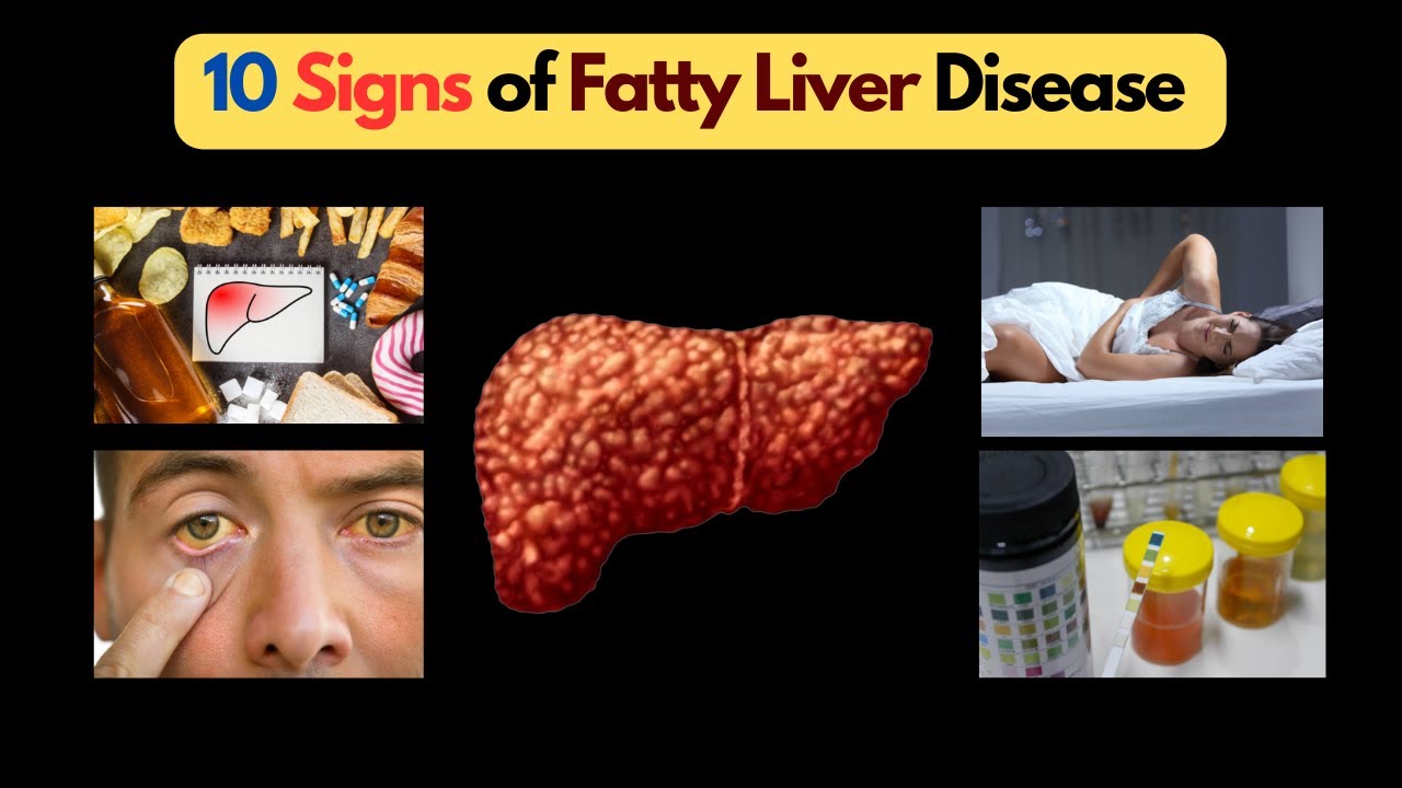 Unlocking the Secrets 10 Signs of Fatty Liver Disease Your Liver