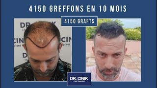 Dr Cinik Greffe De Cheveux Après 10 Mois Hair Transplant Dr Emrah Cinik