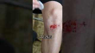 #wound #type of wound -#dressing #nursing #aiims #yt #shorts #shortsfeed #bounds #weakersections