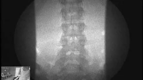 Vancouver Wa | Spinal Decompression| Low Back Pain...