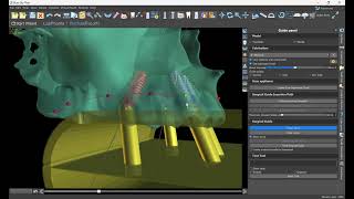 Bone Reduction and Prosthetic Spacing Guide