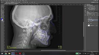 Easy Orthodontics Superimposition in Photoshop
