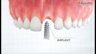 Ask Your Dentist About Dental Implants | Alpha-Bio Tec Wealth