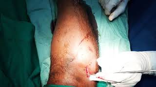 Fracture Both Both Bones Leg With Precarious Skin 2Planar Ex-Fix Adamya Hospital Videos