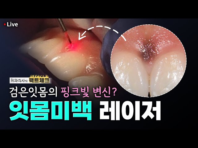 검은잇몸을 분홍빛 잇몸으로 👉실제 잇몸미백 과정 대공개👈