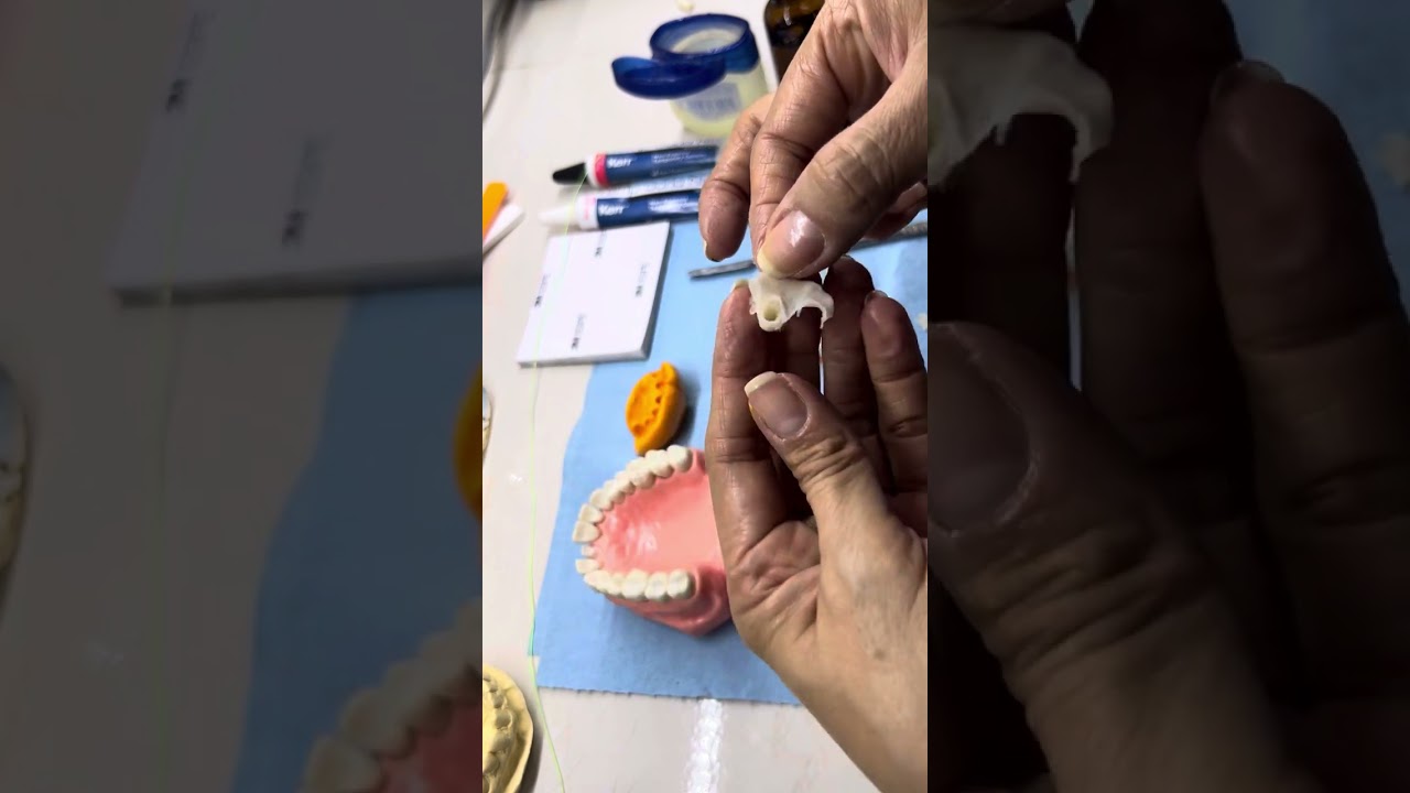 Provisional con técnica de llave de silicon