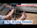 One Big Toe, 10 Long Toenails [Throwback Thursday]