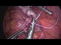 Laparoscopic sigmoidectomy for sigmoid volvulus with natural orifice transrectal extraction