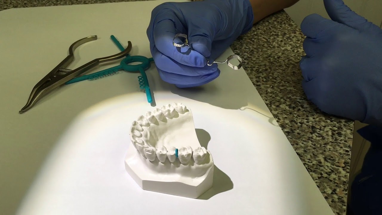 How are Separators Placed and Do They Hurt? YouTube