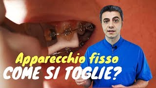 Come si toglie l&#39;apparecchio fisso?